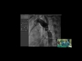 LIVE CASE 20  AndraStent implantation for severe coarctation Yalım Yalçın, Ahmet Çelebi