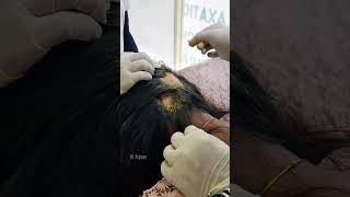 മുടി വട്ടത്തിൽ കൊഴിയുന്നതിന് (Alopecia) ഫലപ്രദമായ ചികിത്സ