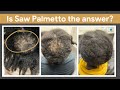 Saw Palmetto: A Game Changer For Hair Loss #sawpalmetto #hairgrowth #hairloss