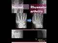 #normal vs rhuemetoid arthritis patients xray of carpals #joint degenerative condition #damage🩺🏥🏥⛑️