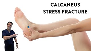 Does shockwave treatment help a calcaneus stress fracture heal?