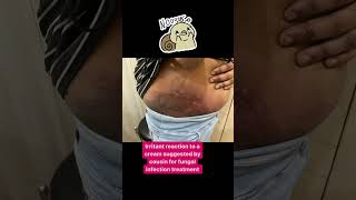 Are you using Derobin cream?| fungal infection treatment | Irritant reaction #drashimagoel #skincare