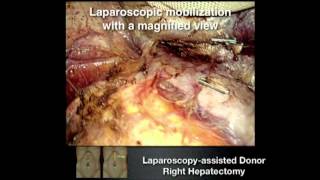 Liver surgery: When to do it open, When to do it laparoscopic, When hybrid?