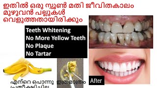 ഒരു സ്പൂൺ മതി ജീവിതകാലം മുഴുവൻ പല്ലുകൾ  Teeth Whitening No Tarter No Plaque Good bye to Yellow teeth