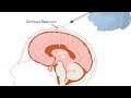 plus therapeutics respect lm clinical trial for patients with leptomeningeal metastases