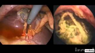 Laparoscopic common bile duct stone clearence: choledochotomy approach