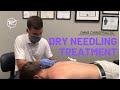 Dry Needling Treatment