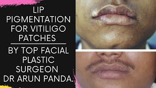 Lip Pigmentation for Vitiligo patches procedure performed in Navi Mumbai by Dr Arun Panda.