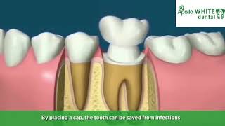 Root Canal Treatment Procedure | Apollo White Dental