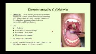 Diphtheria - Medical Common Sense