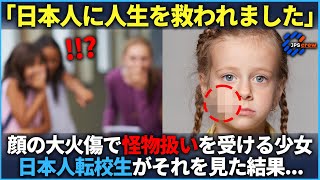 「来てくれてありがとう」アメリカで顔面大火傷でいじめを受ける女の子を日本人転校生の少年が見た結果【海外の反応】