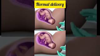 normal delivery# #pregnancytips#trendingshorts#viralsgorts#genderpredictions  #posteriorplacenta