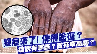 【每日必看】猴痘來了! 傳播途徑? 症狀有哪些? 醫來解答!｜猴痘個案不能排除會再入境 猴痘.天花相比 不治率如何?@中天新聞CtiNews   20220625