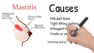 Mastitis - Breast pain during lactation or pregnancy. Mastitis symptoms and treatment.