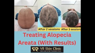 Alopecia Totalis Treatment With Results | VR Skin Clinic | Bikaner