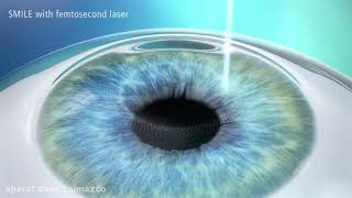 فیلم مقایسه عمل لازک/فمتولیزیک واسمایل چشم دکترمهردادمحمدپورSmile/lasik/lasek09392002452