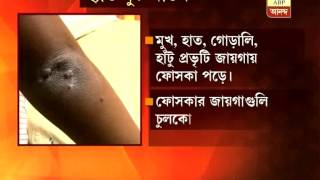 New disease in Kolkata: hand foot mouth disease