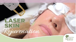 Laser Facial Rejuvenation in Queens NY | Renew Esthetics