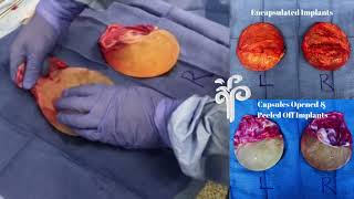 Explant Surgery with En Bloc Capsulectomy - Removal of Breast Implant and Capsule As One Specimen.