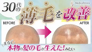 【薄毛対策】リアルすぎる髪を再現！30代男性の悩みを解決するSMP施術に密着！【前編】