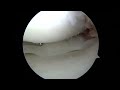 bucket handle meniscus tear repair with circumferential stitches by dr. saliman