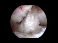 bucket handle meniscus tear repair with circumferential stitches by dr. saliman