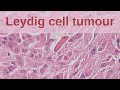 Leydig Cell Tumours of the Testis - Pathology mini tutorial