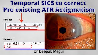 Manual SICS -Temporal Incision to correct  Pre-Existing Against The Rule Astigmatism, Dr DeepakMegur