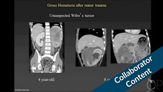 GU Trauma in Children Part 1: Renal Injury by G. Taylor | OPENPediatrics