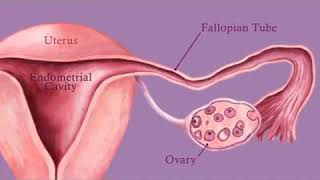 Fallopian Tube Recanalization and Selective Salpingography
