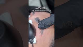 PMU laser removal