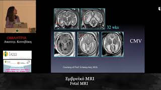 Εμβρυικό  MRI - Αικατερίνη Καναβάκη