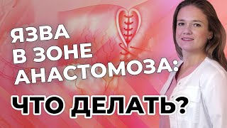 Язва в зоне анастомоза: что делать?