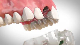 Single Tooth Implant: Step-by-Step Guided Surgery Explained | TeethXpress Procedure