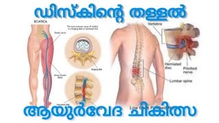 നടുവേദന കാരണവും പ്രതിവിധിയും |Low back pain causes \u0026 remedies