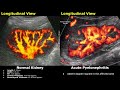 kidney ultrasound normal vs pyelonephritis imaging findings acute chronic u0026 emphysematous types