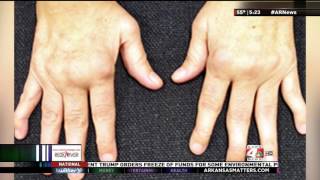 KARK: Dr. Sruthi Kanuru Discusses Wilma Shaw's Journey with Rheumatoid Arthritis