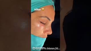 Rhinoplasty, Lower Eyelid Surgery \u0026 Nano Fat Injection to the Face