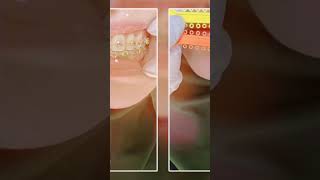 روعة تقويم الأسنان #orthodontics #shorts #short #dentist #dental #anesthesia #beam #dental_student