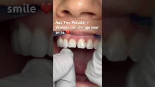 Wow! Just two porcelain veneers can Change your smile !