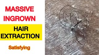 Satisfying Ingrown Hair Extraction: Causes Of An Ingrown Hair And Prevention