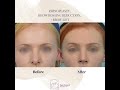 rhinoplasty by dr. rodman