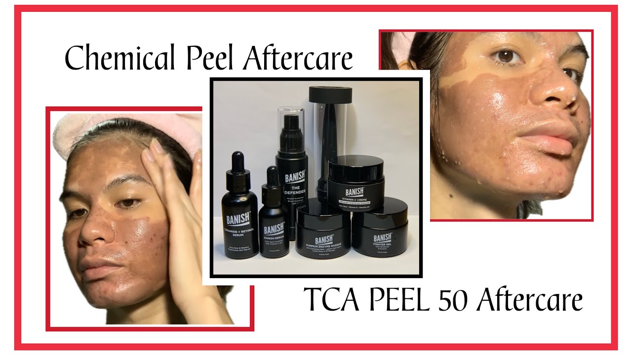 TCA PEEL AFTERCARE | TCA PEEL 50 PERCENT | TCA PEEL AT HOME #diy # ...