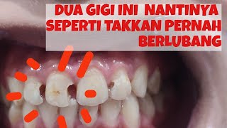 LUBANG GIGI DEPAN ATAS DI TAMBAL, ini prosesnya. BROKEN TOOTH RESTORATION