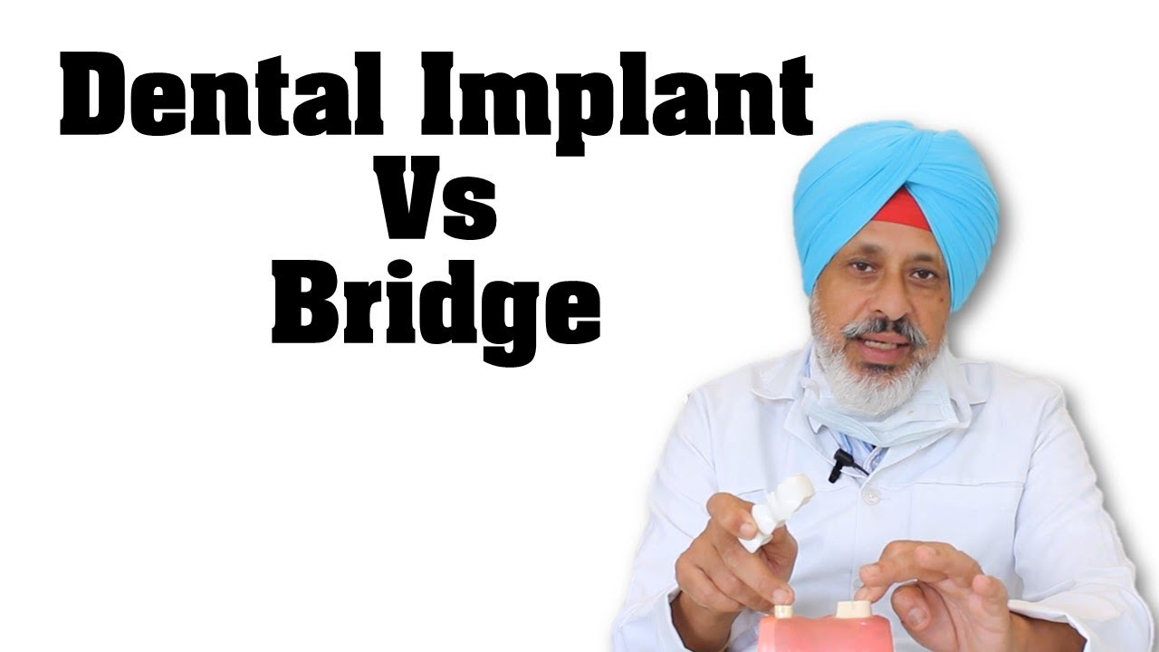 Best Dental Clinic Chandigarh Panchkula Mohali Implant Vs Dental ...