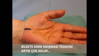 Bilekte Sinir Sıkışması Ameliyatı