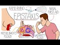 Understanding Epistaxis (Nosebleeds Explained)