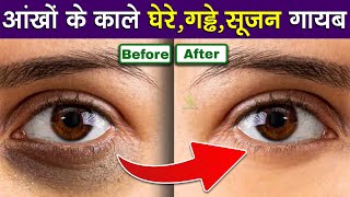 आंखों के काले घेरे गड्ढे सूजन गायब | Dark circles, puffiness and eye swelling disappear !