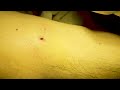 লাইপোমার আধুনিক ট্রিটমেন্ট। lipoma surgery in bangladesh