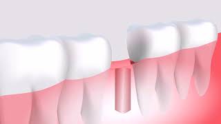 8 important pros and cons of dental implants